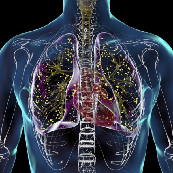 Lungs affected by miliary tuberculosis, illustration